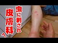 √ 虫 刺され 水ぶくれ 市販 薬 171323-虫刺され 水ぶくれ 市販薬