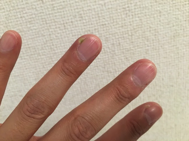 ちょい閲覧注意 ひょう疽 そ になった話 Y氏は暇人