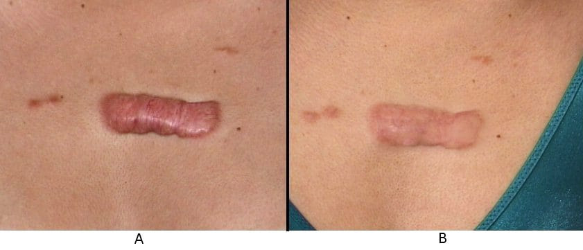 tattoo over scar. Keloid scar on the anterior