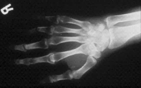 Symptoms Psoriatic Arthropathy | joviri ajihod