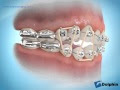 Correcting Posterior Open Bites Using Triangle Rubber Bands