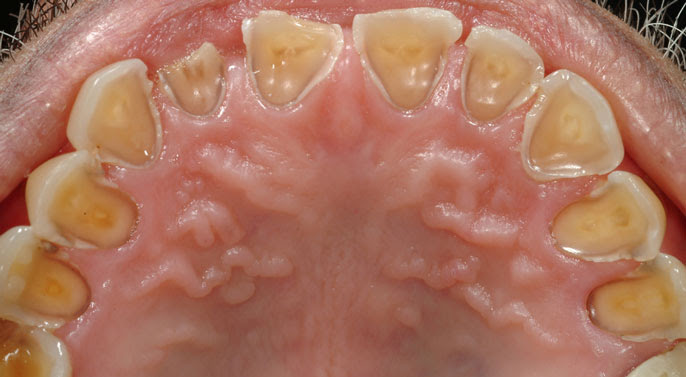 Dental Erosion | Drummoyne Dental Practice