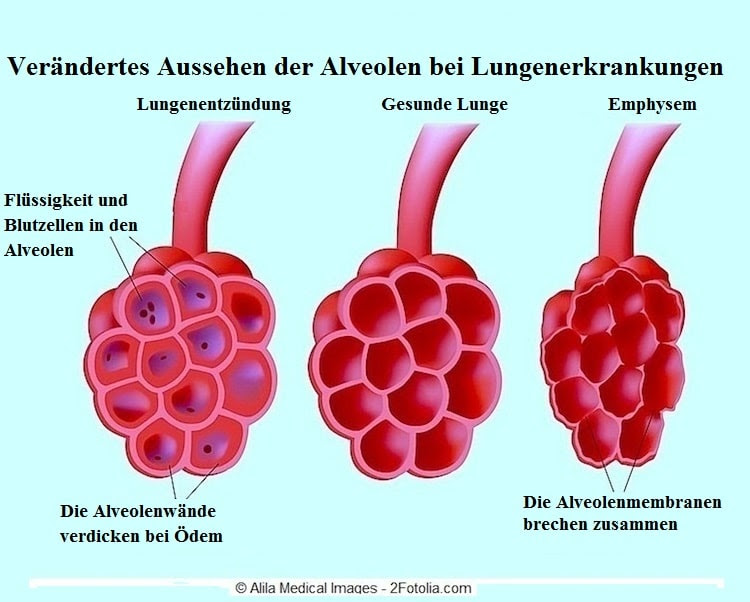 Lungenemphysem, Symptome, Operation und Prognose