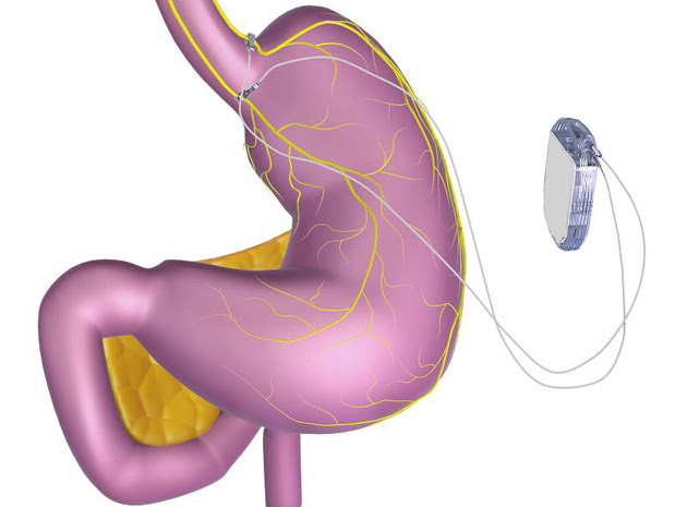 EnteroMedics appetite pacemaker