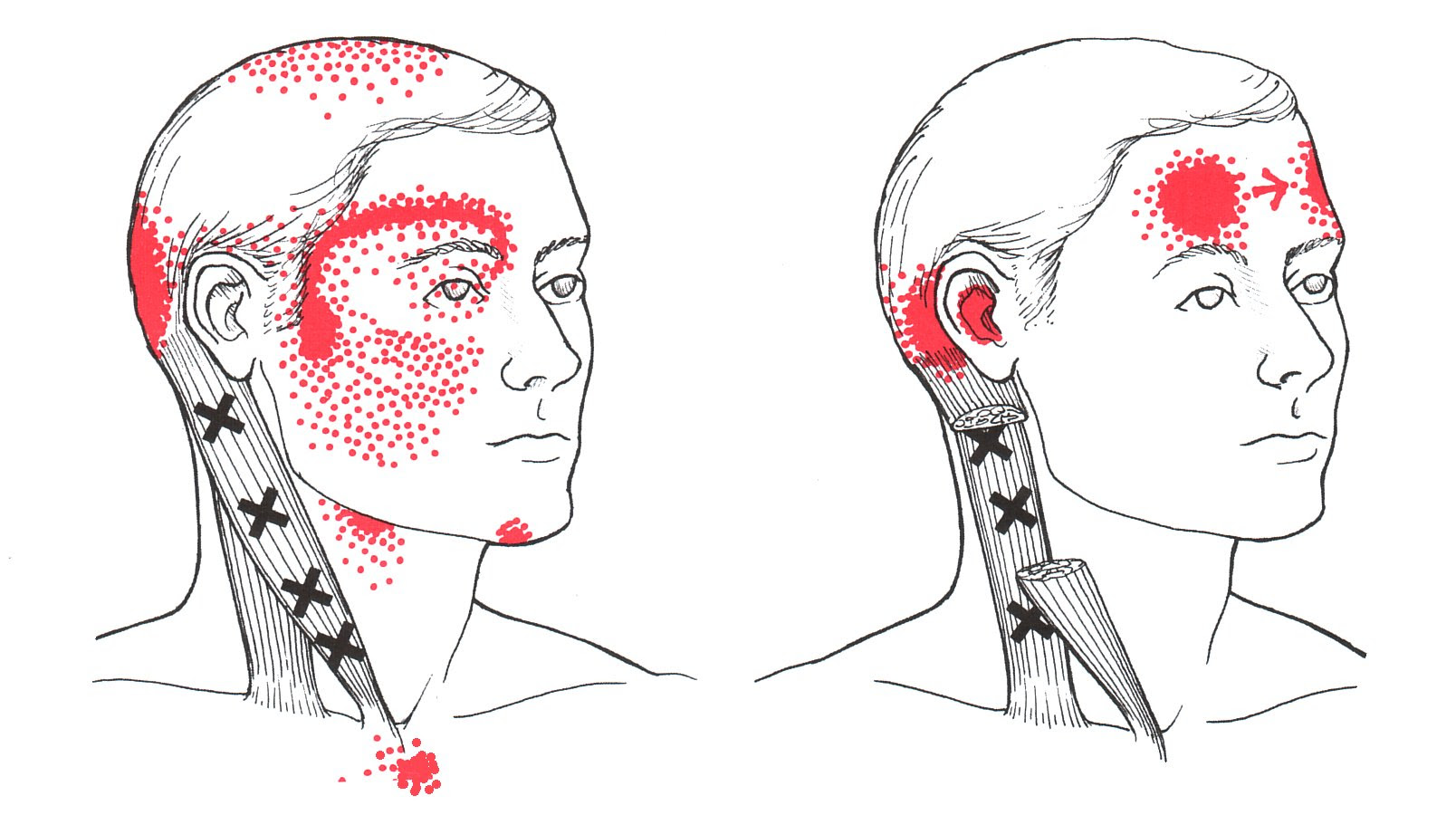 sinus infection signs returned of head
