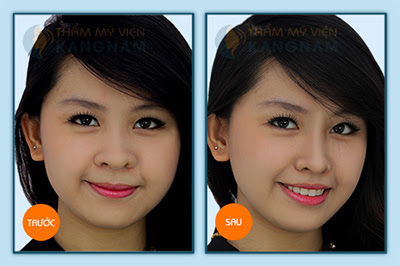 Kết quả nâng mũi của chị Hoài Thương