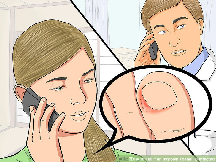 Tell if an Ingrown Toenail Is Infected Step 4.jpg
