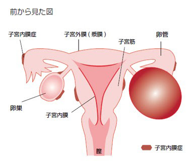 子宮内膜症 公益社団法人 日本産科婦人科学会