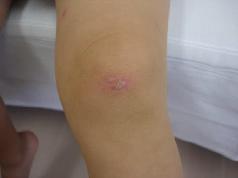 皮膚病 水疱 すいほう 水ぶくれ 皮膚病