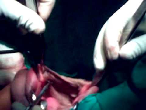 Insitu of Split skin graft in