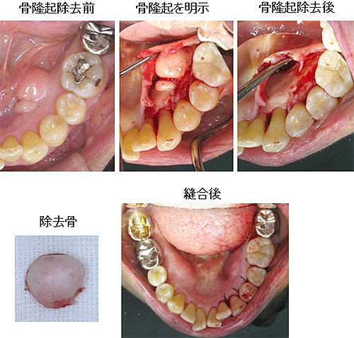 口蓋隆起 又吉歯科医院