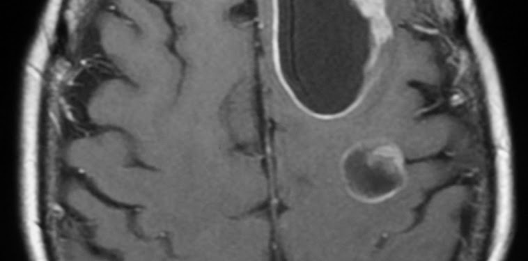 Central Zone Prostate Cancer Mri / Ganglioglioma of the occipital lobe | Image | Radiopaedia.org : Here are 10 more facts about prostate cancer.