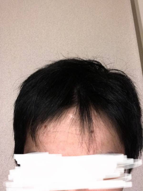 悲報 ワイ若ハゲ いよいよやばい トム速報