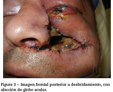 Mucormicosis rinocerebral de origen dental: reporte de un caso clínico y revisión de la literatura