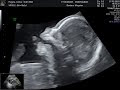 [Le plus préféré] down syndrome echo 3d bebe trisomique 496198