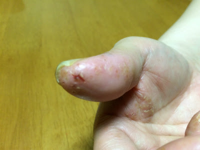 またパックリ割れ 手荒れ百科