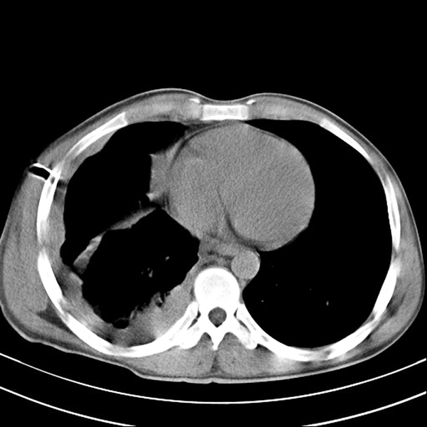 Malignant Mesothelioma Versus Metastatic Carcinoma Of The Pleura A Ct Challenge Iranian Journal Of Radiology Full Text