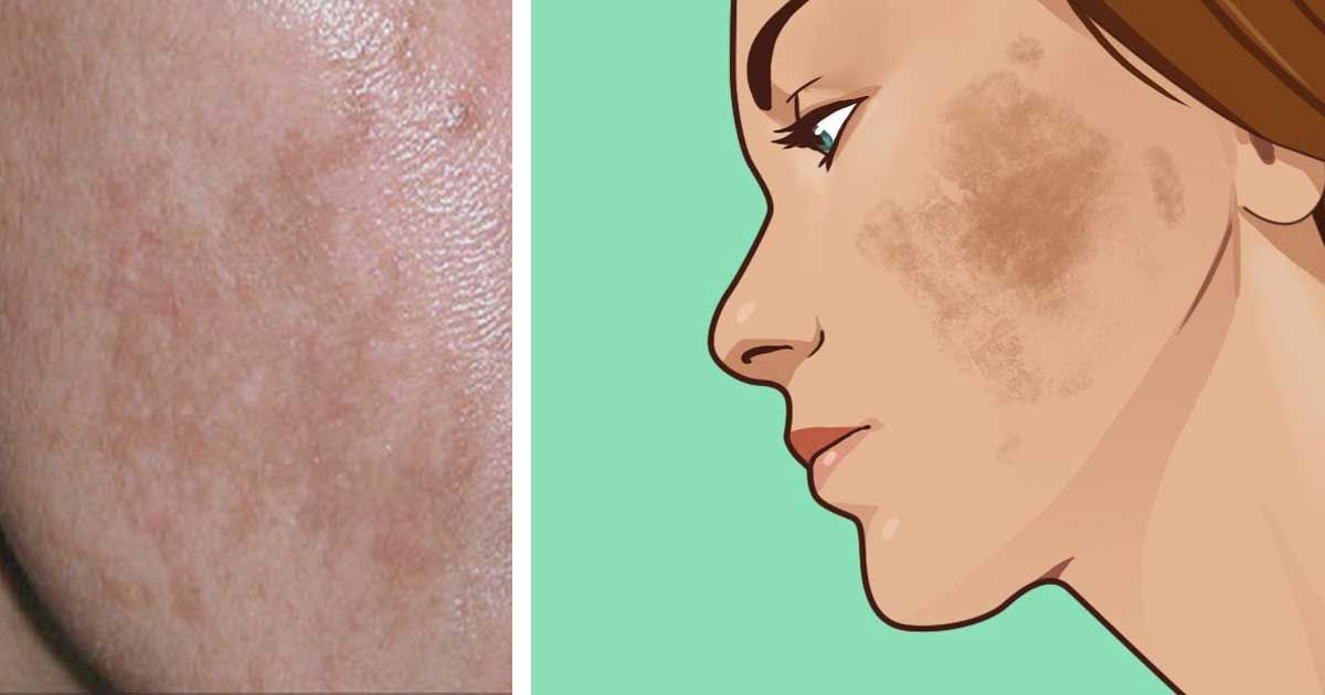 dandruff home remedy lemon juice