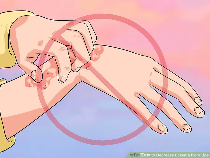 Decrease Eczema Flare Ups Step 10 Version 3.jpg