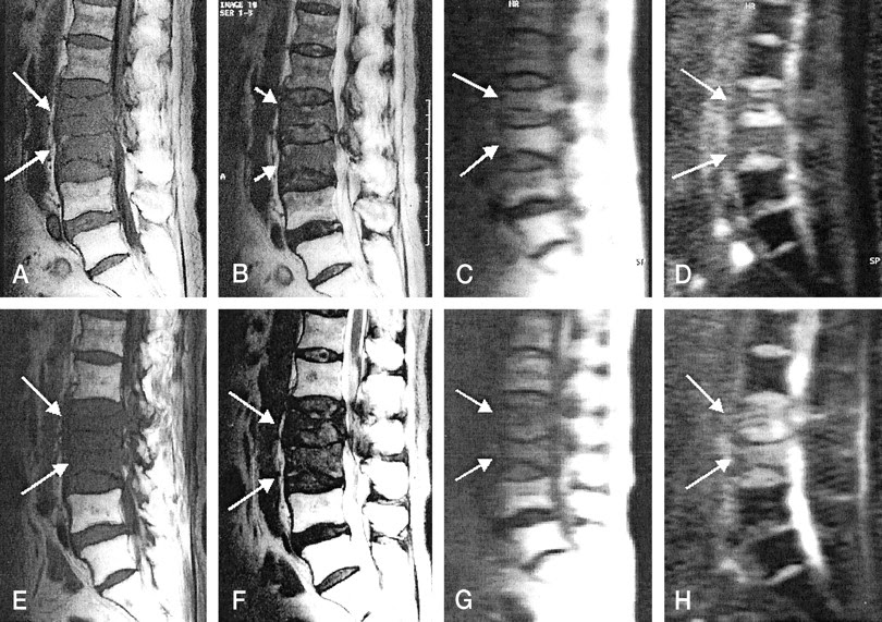 Diffusion Weighted Mr Imaging Of Metastatic Disease Of The Spine Assessment Of Response To Therapy American Journal Of Neuroradiology