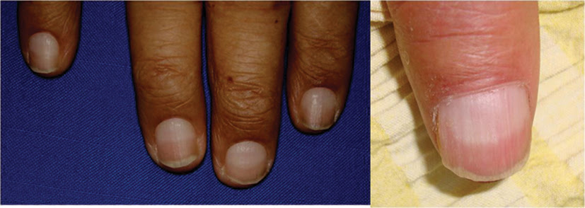 13 4 24 Ungual Our Dermatology Online Journal