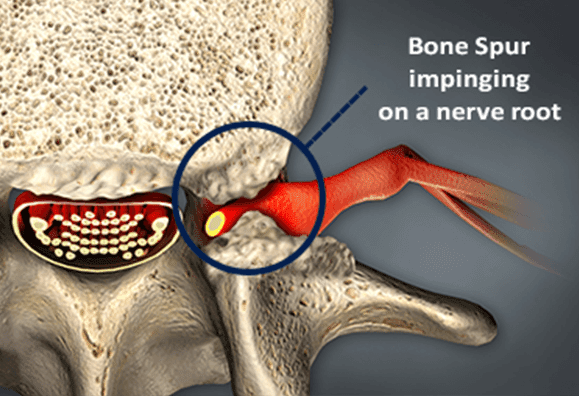 Bone Spurs - Osteophytes | Causes, Symptoms & Treatment