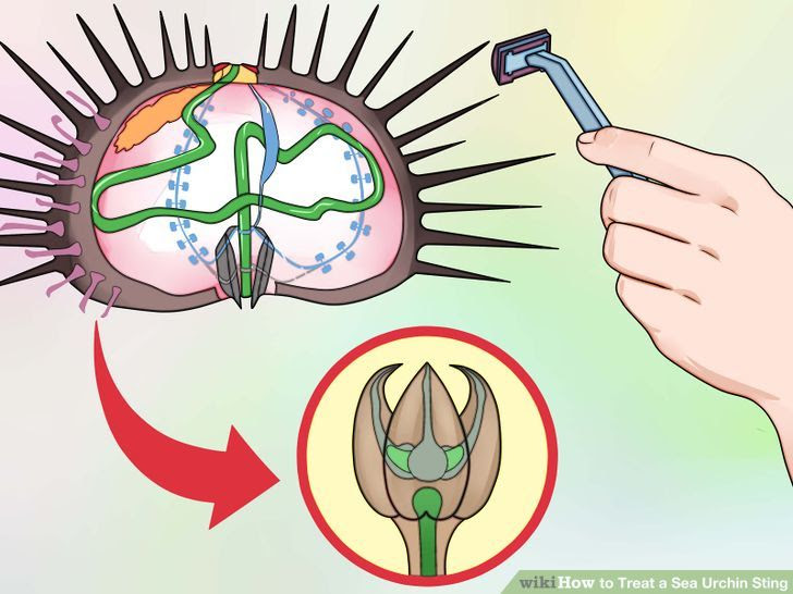 Treat a Sea Urchin Sting Step 4 Version 2.jpg