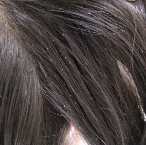 Head Lice How To Identify Head Lice And Nits