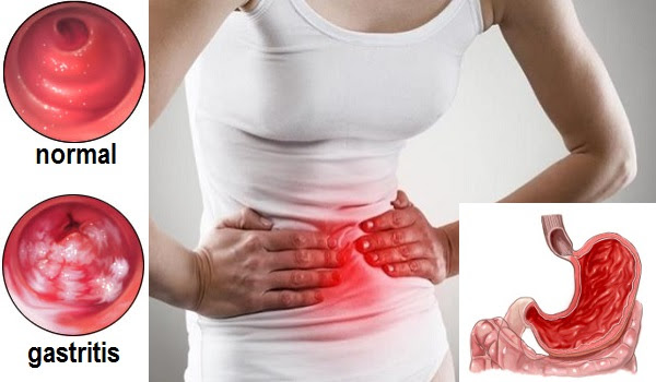 What are some remedies for Gastritis?