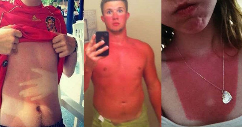 18 people who are walking around with terrible sunburns.