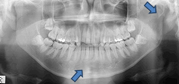 顎顔面外傷について 宮崎大学医学部 感覚運動医学講座 顎顔面口腔外科学分野