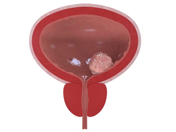 Prostate Cancer Treatment Wikipedia / Current Health ArticlesXeroderma Pigmentosum - Pictures : Although screenings for prostate cancer are one tool for early detecti.