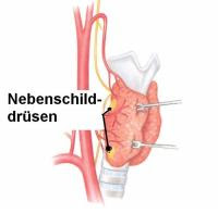 Nebenschilddruse Menden Katholische Kliniken Im Markischen Kreis