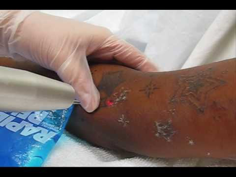 ... Removal Procedure - Tattoo Removal Centers Of America | DIY Reviews