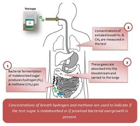 small intestinal bacterial overgrowth sibo dr hagmeyer