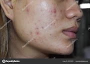 Black spot and it's treatment 
