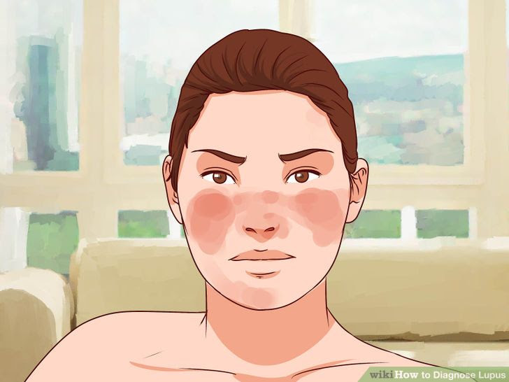 Diagnose Lupus Step 1.jpg