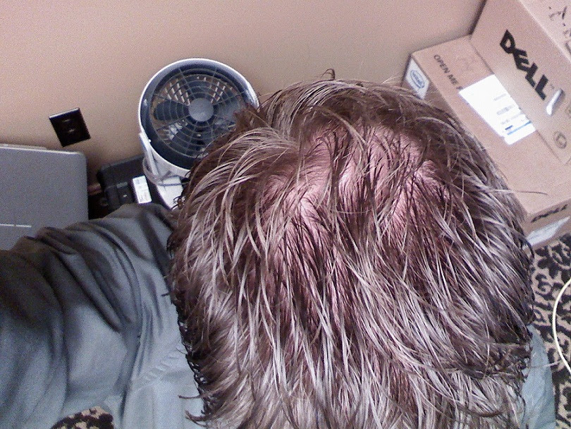 Lpt Request Male Pattern Balding Reversal Lifeprotips