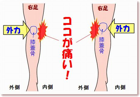 ひざ治療 ３０分で痛み消える 靭帯損傷 膝 慢性病の治療 方法とは 慢性的な膝の痛みの症状は治らない キネシオテープにテラヘルツ加工