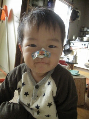 こうちゃん めでたく２歳に そして おたんじょう日に 抜糸 アカルク タノシク ホガラカニ