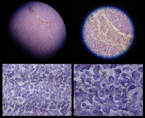 Micrographs showing mesothelioma in a core biopsy.
