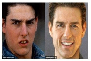 Tom Cruise - before and after smile