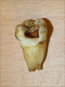 Dente di John Lennon