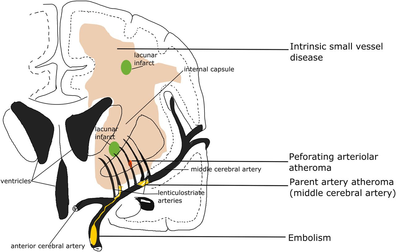 Understanding microvascular ischemic disease: Causes