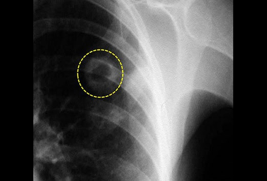 radiothérapie tumeur cérébrale