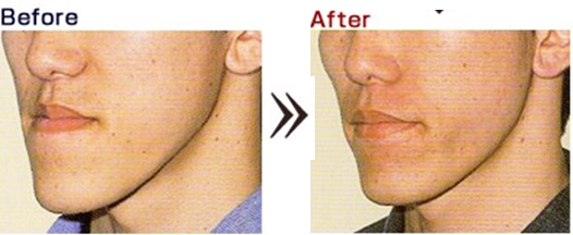 知って得する病気の話 顎変形症のお話 歯科口腔外科 彦根市立病院