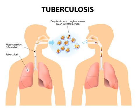tuberculosis types  treatment  prevention