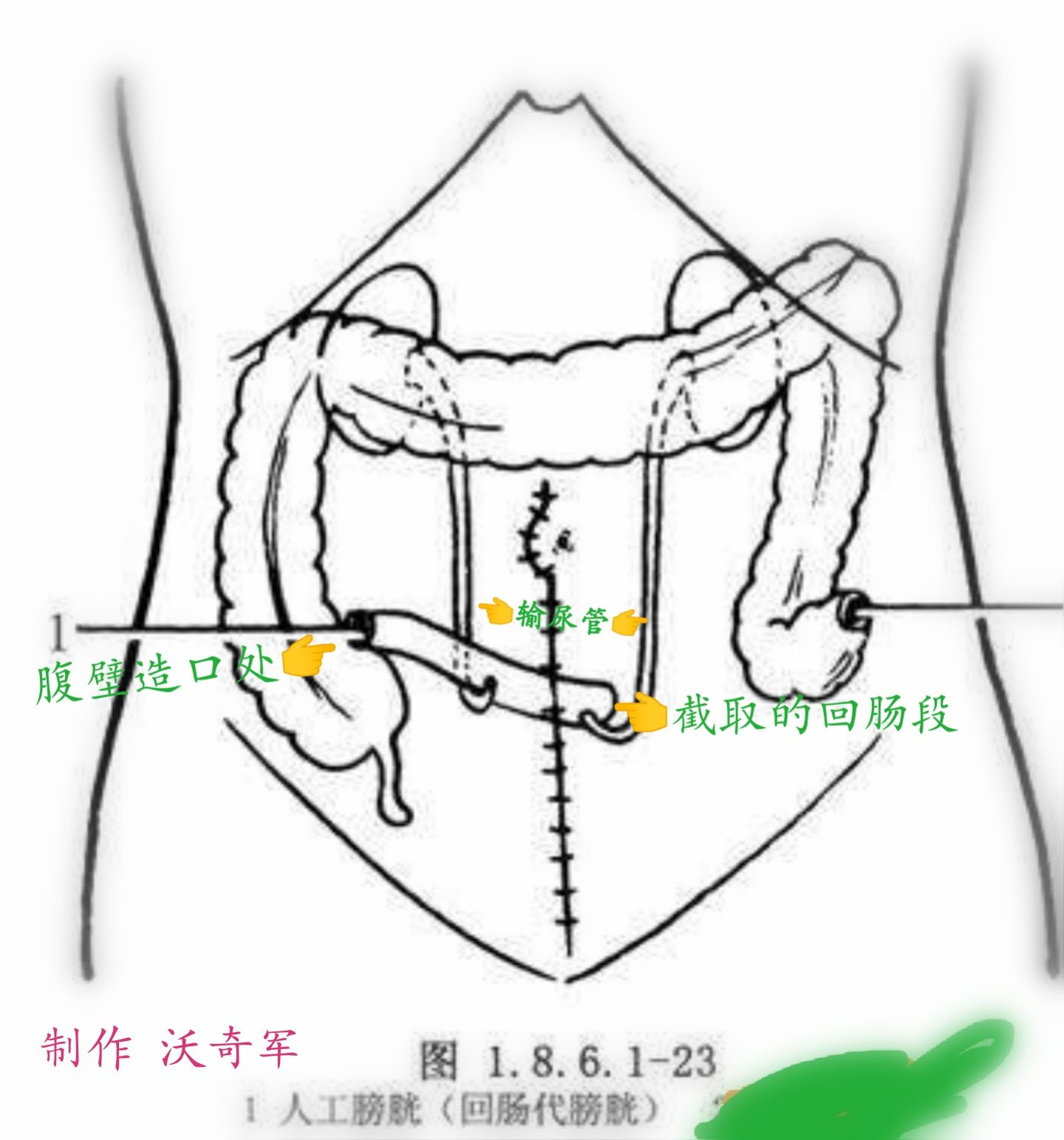 膀胱造口图片 万图壁纸网
