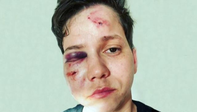 Youtuber lésbica defensora de Bolsonaro sofre agressão homofóbica brutal. Isso a Globo não mostra. Agora se fosse do PT…