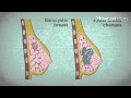 How to Realize Breast Cancer Symptoms